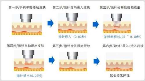 深圳黄金微针多少钱做一次？富华\非凡\米兰柏羽等，价格3千-8千元不等