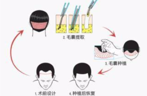 合肥植发价格：2026全新价目表，含FUE/微针/3D等技术费用