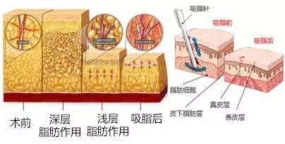 成都黄佳涌和王欣哪个抽手臂厉害？手臂抽脂必看攻略，含26年价格表