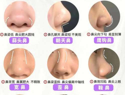 合肥隆鼻修复多少钱？2026收费细节展示！含推荐医院