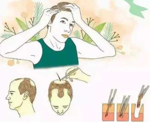植发三千个单位多少钱
