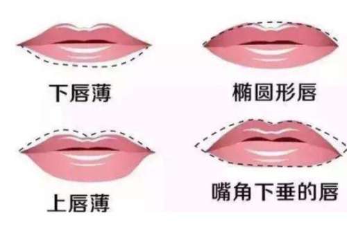 大连市嘟嘟唇玻尿酸多少钱