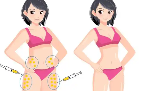 上海国际医学中心抽脂多少钱？腰腹、大腿、手臂吸脂费用拆解