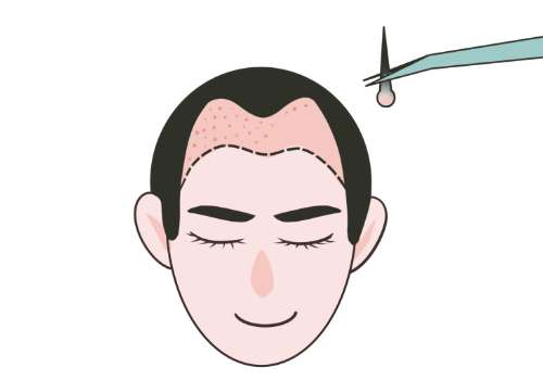 南昌大学第二附属医院植发怎么收费？8k起，杨娟敏提取/种植技术稳！