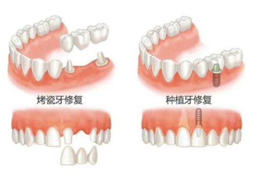 西安种植牙多少钱？集采后各品牌价格透明公开