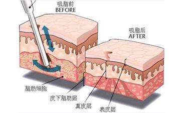 杭州维多利亚马腾抽脂怎么样？国十大吸脂大咖医生_面吸价格8000元起