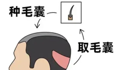 深圳植发要多少钱？全包价/按毛囊计费明细，建议收藏