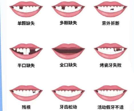汕头种植牙多少钱一颗？热门医院名单公布！
