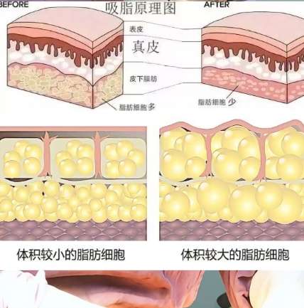 杭州脸部吸脂多少钱？费用是2万元左右起|口碑医院介绍！