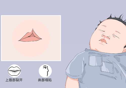 兰州修复唇裂好正规医院是哪家？26年TOP榜前4医院介绍来了