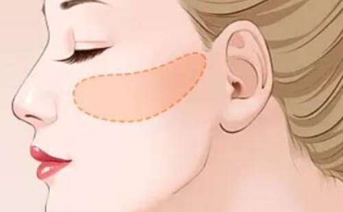 南京医科大学第二附属医院沈干微创颧骨整形多少钱?技术测评&术后120天案例