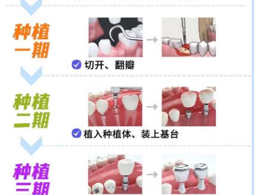 汉中种植牙多少钱一颗？国产种植牙3967元起！名单公布