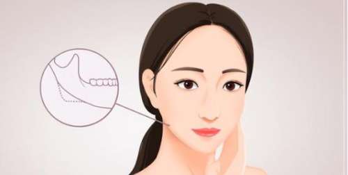 下颌角和颧骨一起整多少钱？手术安全性如何？注意事项介绍