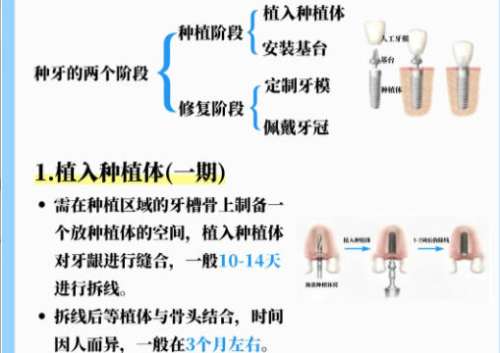 苏州种牙多少钱一颗啊?费用在3k至1w不等含人气医院推荐!