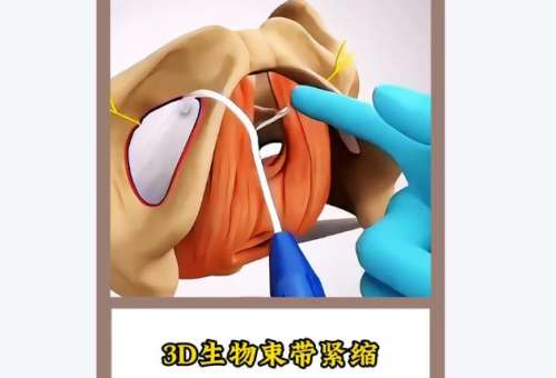 深圳怡康妇产医院阴道紧缩术到底多少钱？2026价格1.6万-3.5万元不等！