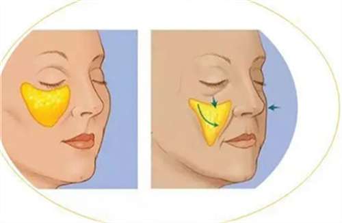 自体脂肪填充价格高不高？全新价格发布，收藏