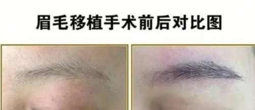 植眉毛一般价格要多少钱 