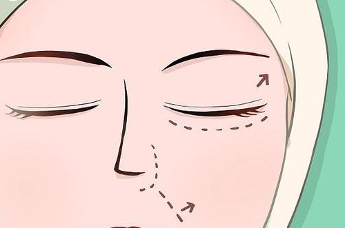 肿眼泡该如何做割双眼皮？内附术后注意事项