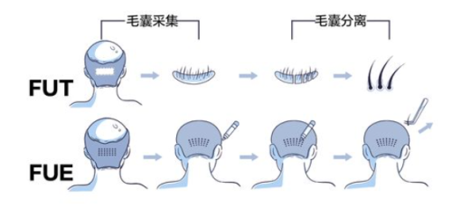 青岛植发的价格一般是多少？按技术/毛囊数分类报价，建议收藏