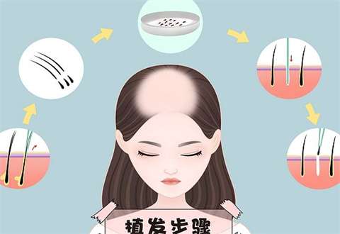 成都双禾植发医院价格贵吗？医生队伍如何？2026实测~
