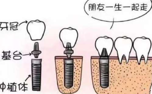 潍坊种一颗牙大概要多少钱？不适合哪类人