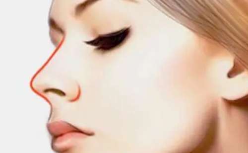 郑州大学第一附属医院郑东院区张景霞耳软骨隆鼻案例欣赏&价格一览表?