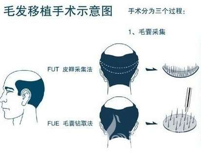 张健医生植发多少钱？山东省立口碑专家，毛发移植收费1.5万-4.5万元不等