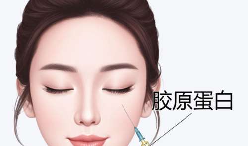 济南打胶原蛋白针多少钱？大概是4800~15,800元左右！