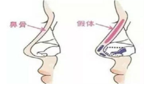 鼻子整形怎么样？整形失败后可以再次修复吗？