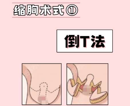 武汉缩胸手术一般多少钱啊？费用低至2万4左右！含推荐医院
