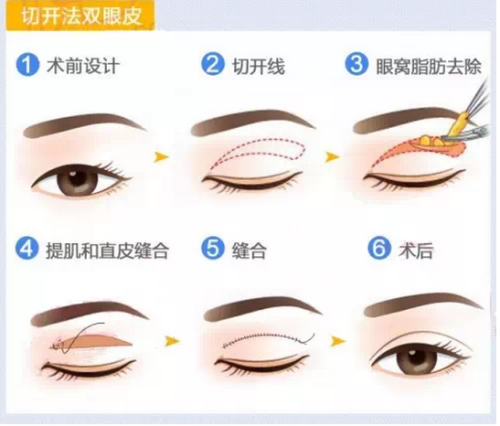 长沙做双眼皮多少钱？全切/定点/埋线分类报价，建议收藏