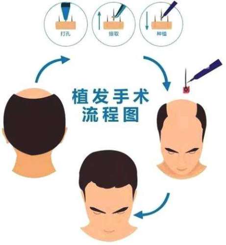 男生植发大概需要多少钱？2026价格表_正规公立医院实力测评