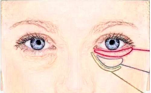 广东省第二人民医院孙中生切眼袋案例欣赏|技术评价怎么样?价目表