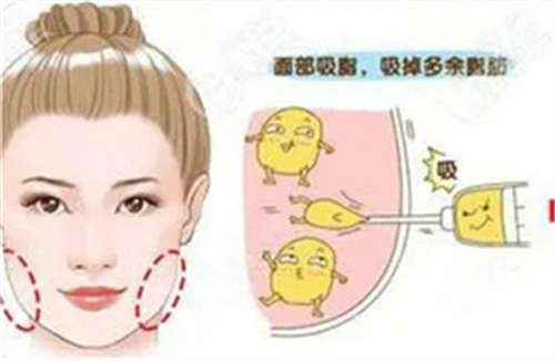 吸脂瘦脸要多少钱？看全新价格汇总，点击查看