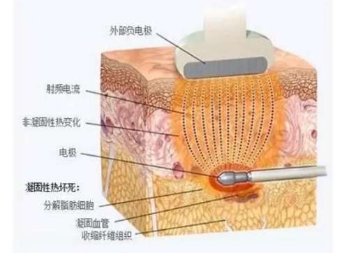 最安全先进的吸脂方法是什么？多种吸脂方法特色介绍