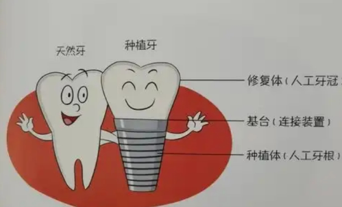 南通口腔医院种植牙多少钱一颗？公立院真实收费曝光，附各品牌价格明细