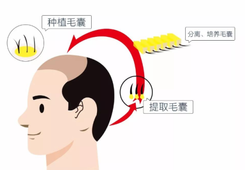 不剃发植发成都双禾植发能做吗？跟普通植发有什么区别？附价格参考