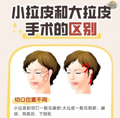 成都做大拉皮多少钱？2026费用低至3万2左右！