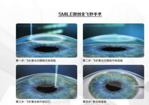 郑大一附院近视手术多少钱？2026年价格全揭秘，看完这篇再决定！
