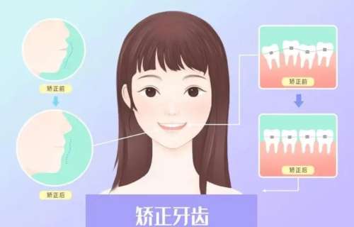 骨性凸嘴矫正手术多少钱？大概需要6500元到24800元