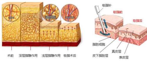 台州维多利亚吸脂多少钱-2026年面吸6k元起\腰腹环吸1.2w元起...
