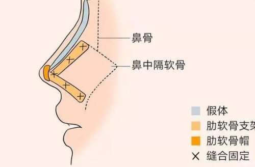 合肥鼻子整形手术价格贵吗？参考费2.5w元起|2026年费用表曝光