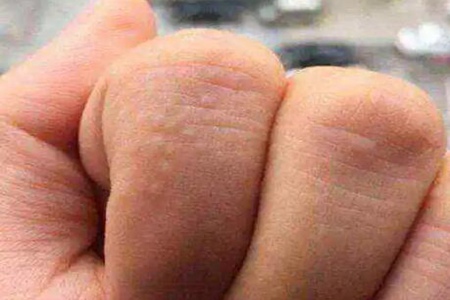 湿气重有什么症状？这五个症状不能忽视及时改善