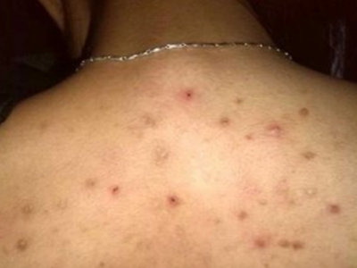 背上长痘痘怎么办