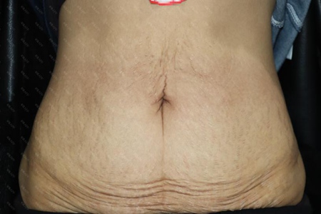 妊娠纹是如何产生的 怀孕期间如何避免怎样消除