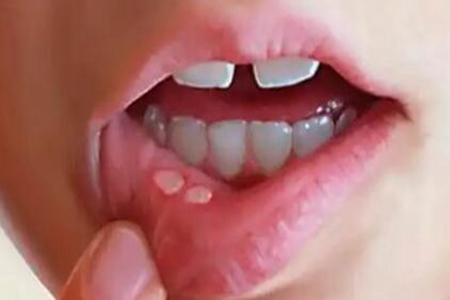 儿童口腔溃疡怎么办？（五个方法有效解决口腔溃疡问题）